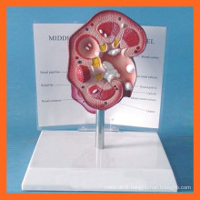 Medical Kidney Model Anatomical Model of Renal Stones